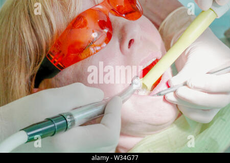 The most common method to remove the tooth decay in and around the cavities was drilling it out and catching the decay as early as possible Stock Photo