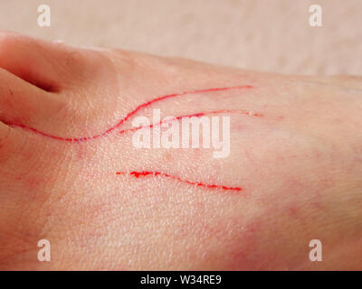 Cat scratches on foot. Stock Photo