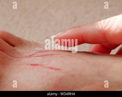 Application of antibiotic creme to cat scrathes on foot. Stock Photo