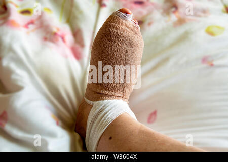 Bandaged foot a few hours after bunion and hammertoe surgery on the right foot of a woman in her 60's. First day of foot surgery. Stock Photo