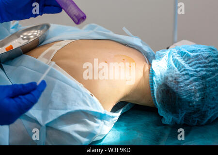 The surgeon does surgery to remove the mole on the patient's back. The process of burning moles in a private clinic to remove moles. Stock Photo
