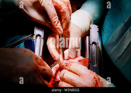 Suture of an lung emphysema surgery in an infant andmedical assistance close-up Stock Photo