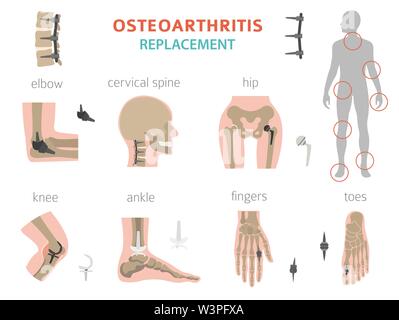 Arthritis, osteoarthritis medical infographic design. Joint replacement ...