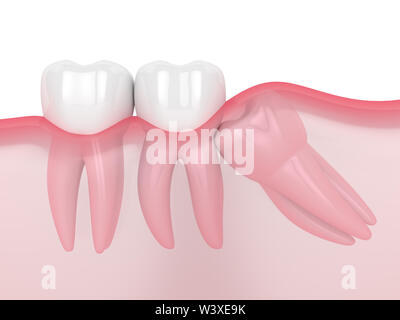 3d render of jaw with wisdom mesial impaction over white background. Concept of different types of wisdom teeth problems. Stock Photo