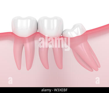 3d render of jaw with wisdom mesial impaction over white background. Concept of different types of wisdom teeth problems. Stock Photo