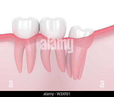 3d render of jaw with wisdom distal impaction over white background. Concept of different types of wisdom teeth problems. Stock Photo