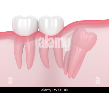 3d render of jaw with wisdom distal impaction over white background. Concept of different types of wisdom teeth problems. Stock Photo