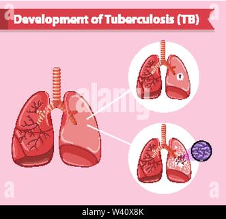 Tuberculosis Abstract Scientific medical illustration of tuberculosis illustration Stock ...