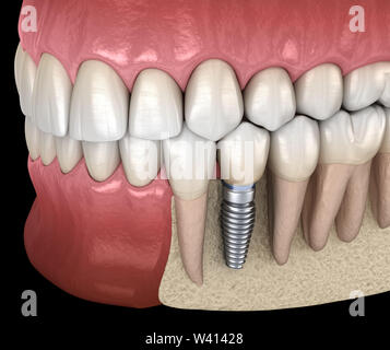 Premolar tooth recovery with implant. Medically accurate 3D illustration of human teeth and dentures concept Stock Photo