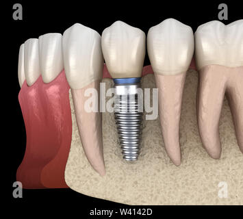 Premolar tooth recovery with implant. Medically accurate 3D illustration of human teeth and dentures concept Stock Photo