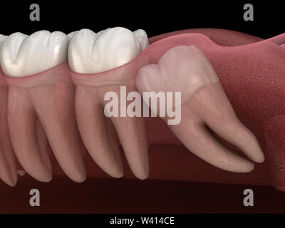 Healthy teeth and wisdom tooth with mesial impaction . Medically accurate tooth 3D illustration Stock Photo