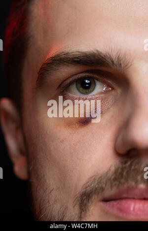 Man with shiner bruise black eye hematoma Stock Photo
