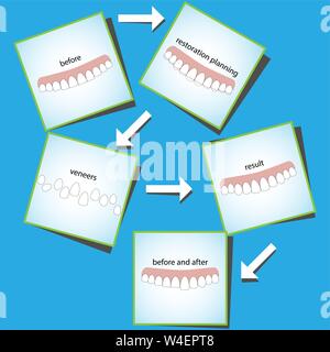 Veneers dentistry, great design for any purposes Stock Vector