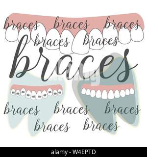 Braces dentistry in beautiful style. Vector flat design illustration Stock Vector