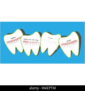 Veneers dentistry, great design for any purposes Stock Vector