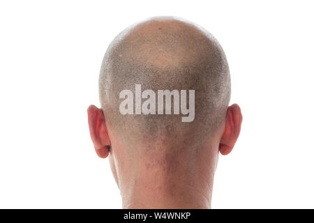 Bald Man Back View Head With Hair Loss Stock Photo 255584869 Alamy