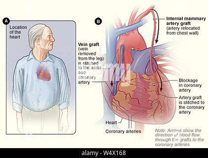 Coronary artery bypass grafting. Stock Photo
