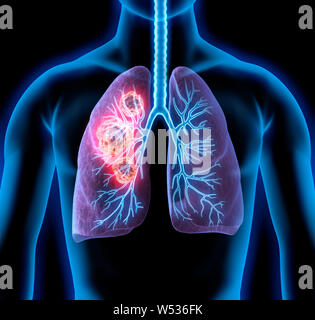 Human body - lungs with tumors - 3d Illustration Stock Photo