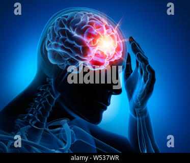 Man with a headache - Stroke -3D Illustration