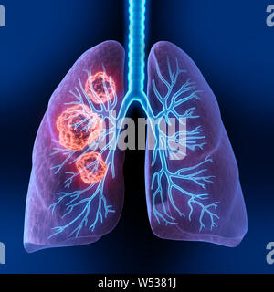 Human body - lungs with tumors - 3d Illustration- 3d Illustration Stock Photo