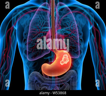 Cancer - Stomach tumor- 3d Illustration Stock Photo