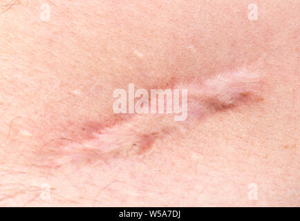Scar on human skin scar or cicatrice after operation on stomach Stock Photo