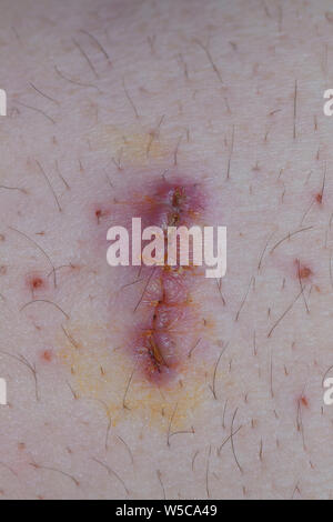 Infected stitched wound (knife cut Stock Photo - Alamy