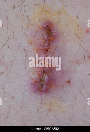 Infected stitched wound (knife cut Stock Photo - Alamy