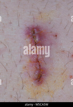 Knife wound surgery scar Stock Photo: 17370961 - Alamy