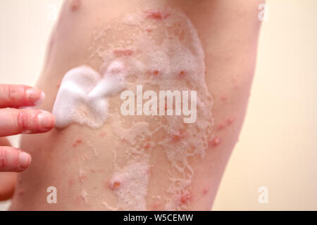 Child skin infected with chickenpox is having treatment using antiseptic foam. Stock Photo