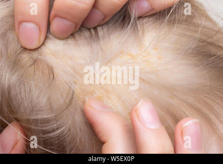 Seborrheic skin rash on the child s head, seborrheic dermatitis, close-up, inflammatory Stock Photo