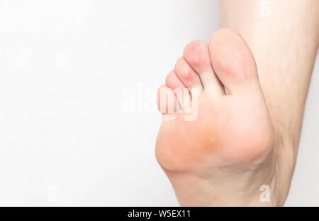 Problem skin with calluses and corns on the sole of the human foot, dry and rough skin, inflammation and pain, foot, close-up, copy space Stock Photo