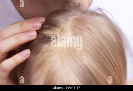 Seborrheic skin rash on the child s head, seborrheic dermatitis, close-up, inflammatory Stock Photo