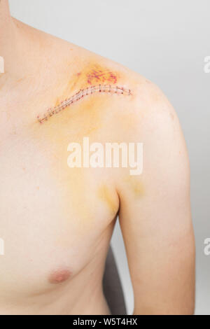 Broken Clavicle After Surgery Stitches Scar Stock Photo  Download Image  Now  Scar Skin Torso  iStock