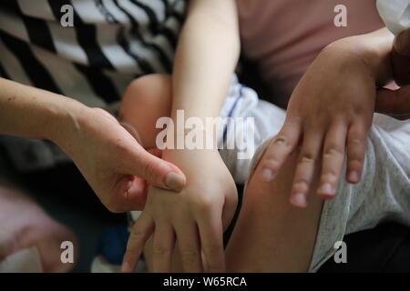 Chinese care worker Zhang Xia looks after the 7-year-old boy Peng Peng who was seriously injured due to his stepmother's cruel treatment at a hospital Stock Photo