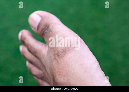 scar on foot Stock Photo