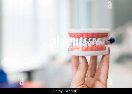 Model of human jaw with wire braces attached. Dental and orthodontic office presentation tool, isolated on female hand.Metal and ceramic braces on Stock Photo