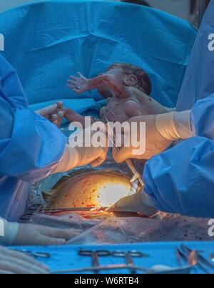New life, baby being born via Caesarean Section in the operating room. Stock Photo