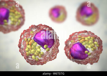 Macrophage foam cell, illustration. Foam cells are macrophage cells that contain lipid droplets and are components of atherosclerotic plaque. Stock Photo