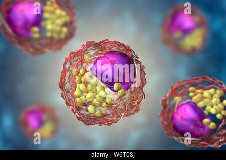 Macrophage foam cell, illustration. Foam cells are macrophage cells that contain lipid droplets and are components of atherosclerotic plaque. Stock Photo