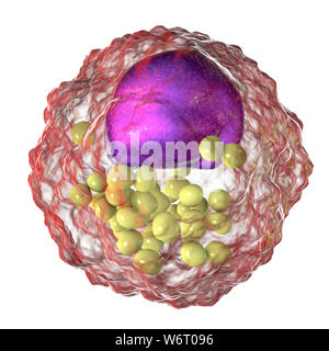 Macrophage foam cell, illustration. Foam cells are macrophage cells that contain lipid droplets and are components of atherosclerotic plaque. Stock Photo