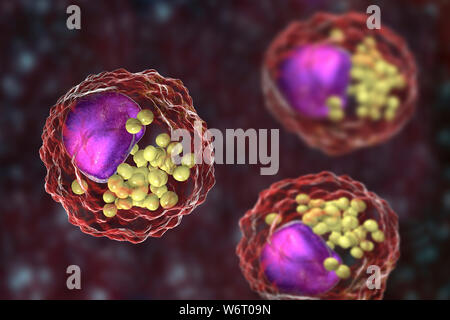 Macrophage foam cell, illustration. Foam cells are macrophage cells that contain lipid droplets and are components of atherosclerotic plaque. Stock Photo