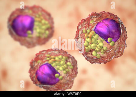 Macrophage foam cell, illustration. Foam cells are macrophage cells that contain lipid droplets and are components of atherosclerotic plaque. Stock Photo