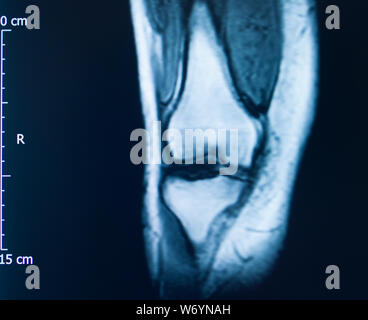 Knee sports injury mri mcl grade 2 tear magnetic resonance imaging orthopedic traumatology scan. Stock Photo