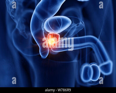 3d rendered medically accurate illustration of prostate cancer Stock Photo