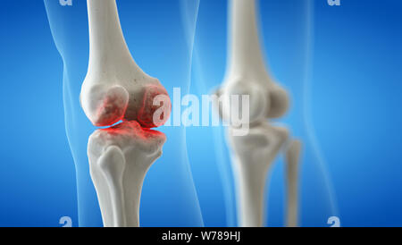 3d rendered medically accurate illustration of an arthritic knee joint Stock Photo