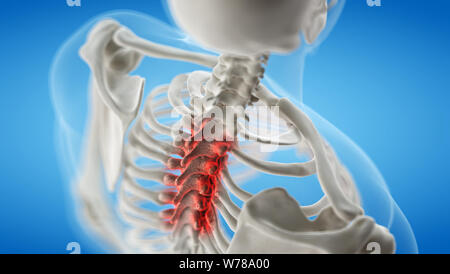 3d rendered medically accurate illustration of an arthritic thoracic spine Stock Photo