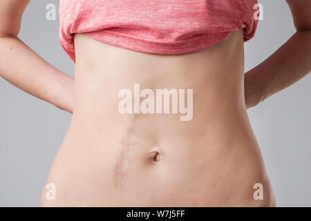 European woman with long abdominal scars after operation Stock Photo