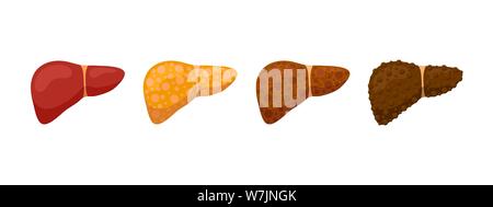 Stages human liver damage concept. Healthy liver steatosis fatty NASH fibrosis and cirrhosis. Vector cartoon medical reversible and irreversible condition illustration Stock Vector