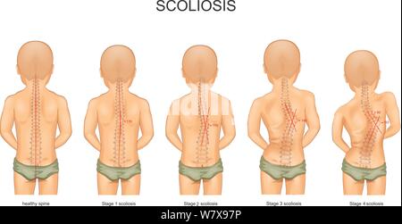 vector illustration of scoliosis stage in children Stock Vector